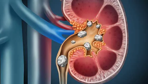 Kidney Stone