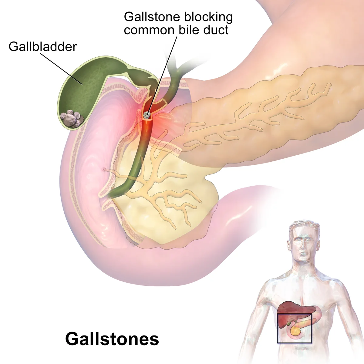 Gallbladder Stone